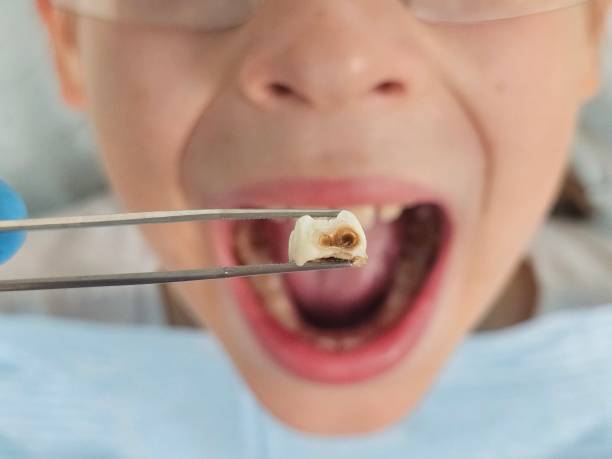 Best Emergency Broken Tooth Repair in Merrillville, IN